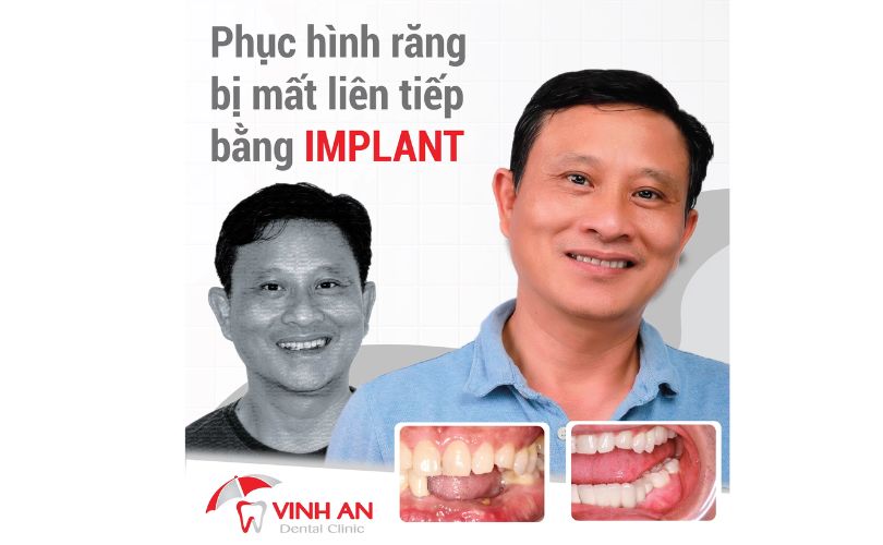 Trồng Răng Implant Có Nguy Hiểm Không? Những Biến Chứng Bạn Có Thể Gặp