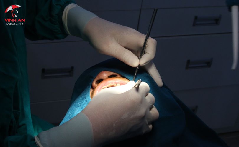 Trồng Răng Implant Có Nguy Hiểm Không? Những Biến Chứng Bạn Có Thể Gặp