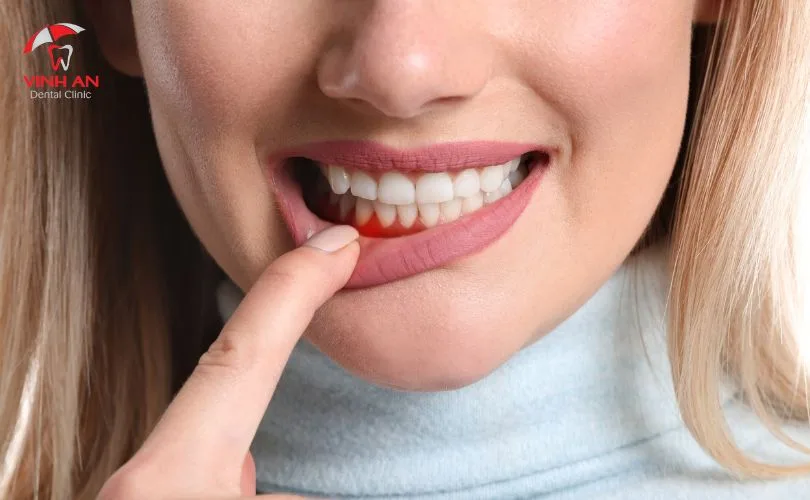 BỊ NHA CHU CÓ BỌC RĂNG SỨ ĐƯỢC KHÔNG?
