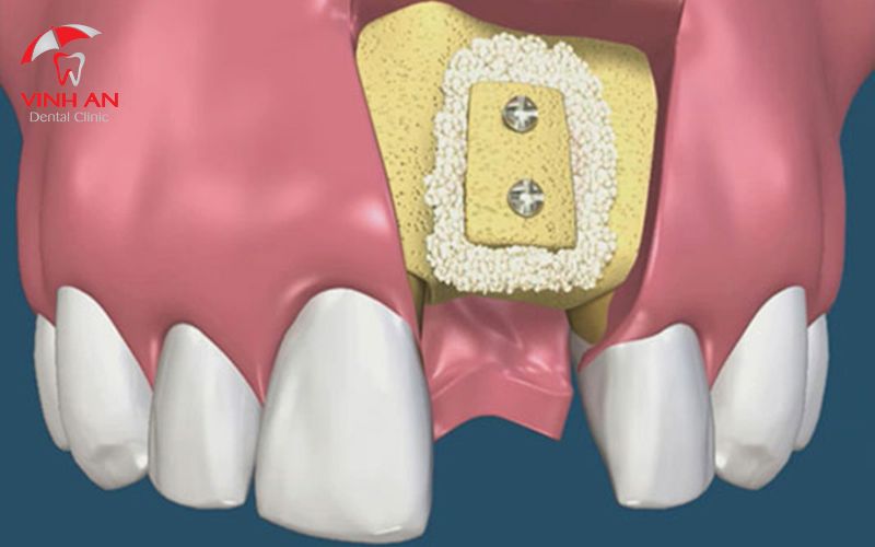 Trường hợp phải cấy ghép xương trước khi cấy ghép Implant