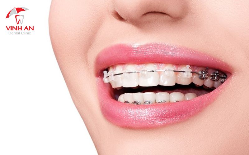 Trường hợp phải niềng răng trước khi trồng răng Implant
