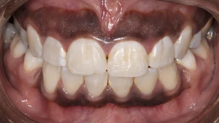 Răng kim loại bị đen khi nào và cách xử lý?