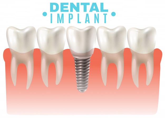 Trồng Răng Implant Có Bị Hôi Miệng Không ? Nguyên Nhân Và Giải Pháp