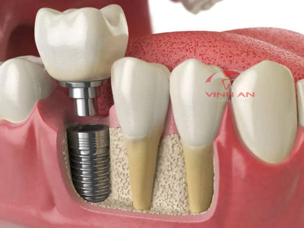 Trồng Răng Implant Bị Đào Thải - Nguyên Nhân Và Cách Khắc Phục