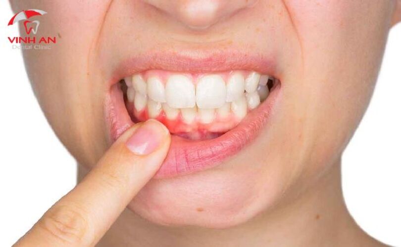 lưu ý khi trồng răng Implant