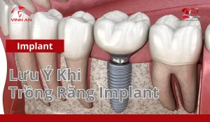Lưu ý Khi Trồng Răng Implant
