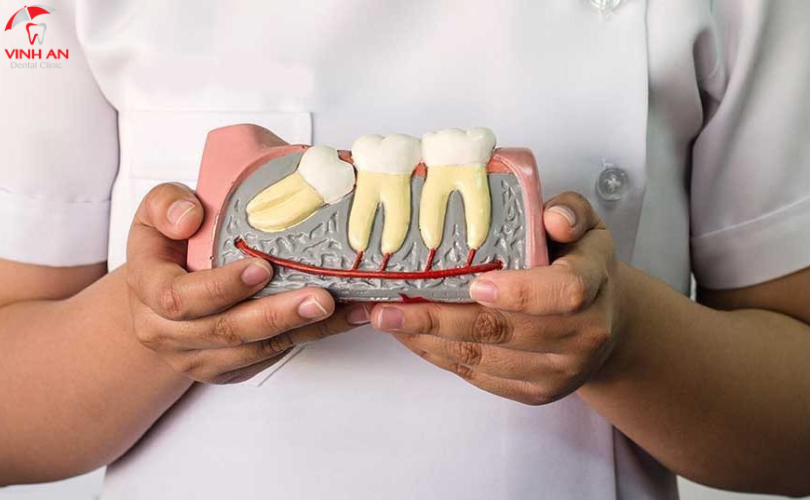 Chăm sóc răng đúng cách sau Niềng Răng