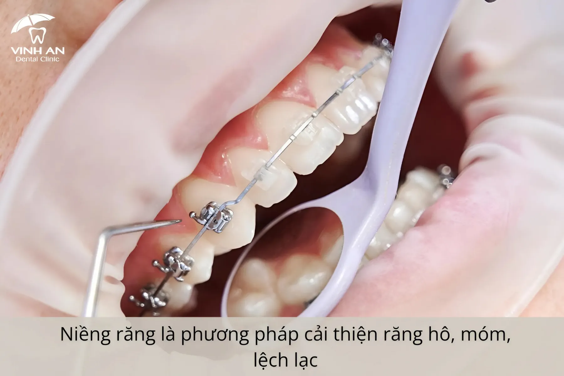 Nieng-rang-la-gi (5)