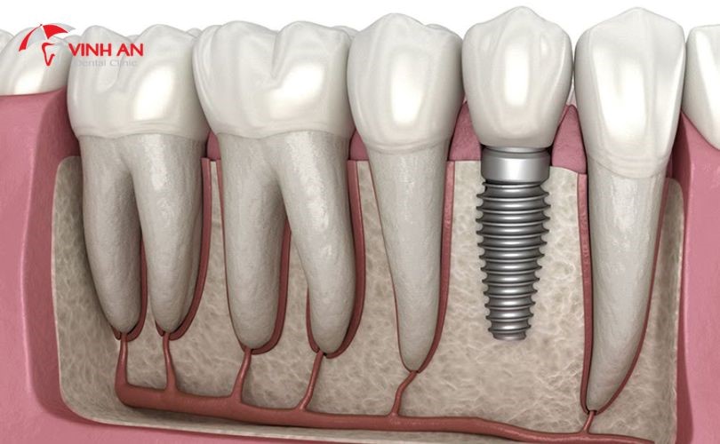Quy Trình Trồng Răng Implant 11