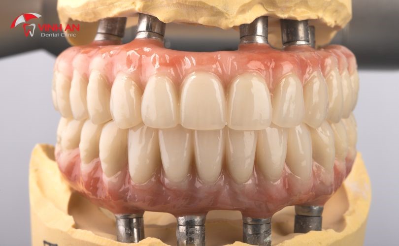 Quy Trình Trồng Răng Implant 4