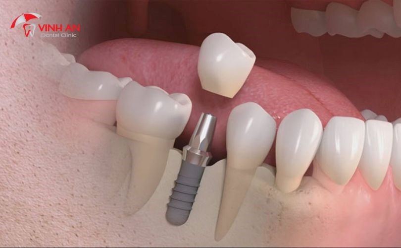 Quy Trình Trồng Răng Implant 6