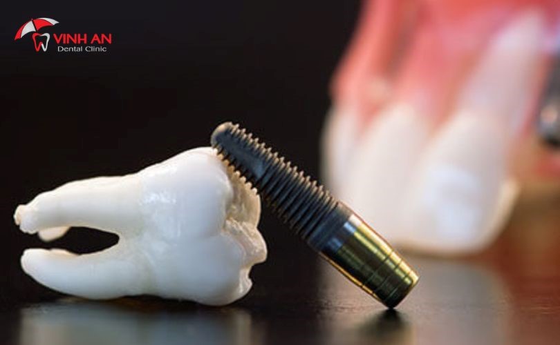 Quy Trình Trồng Răng Implant 7