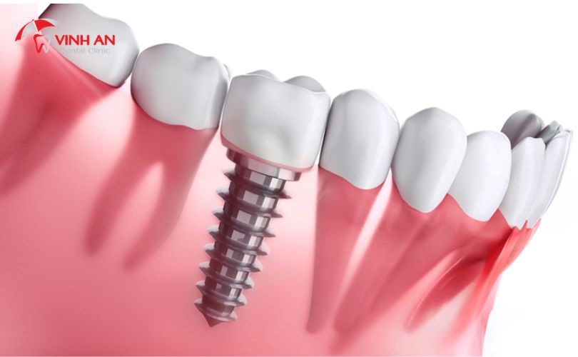Quy Trình Trồng Răng Implant 9