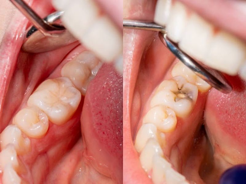 Răng Cấm Là Răng Nào? Nhổ Răng Cấm Có Nguy Hiểm Không?