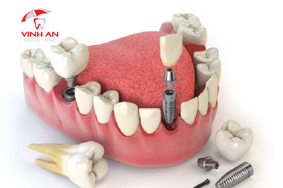 Trồng Implant có nguy hiểm không