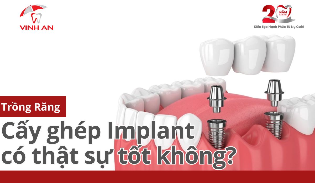 Trồng Răng Bằng Cấy Ghép Implant Có Thật Sự Tốt