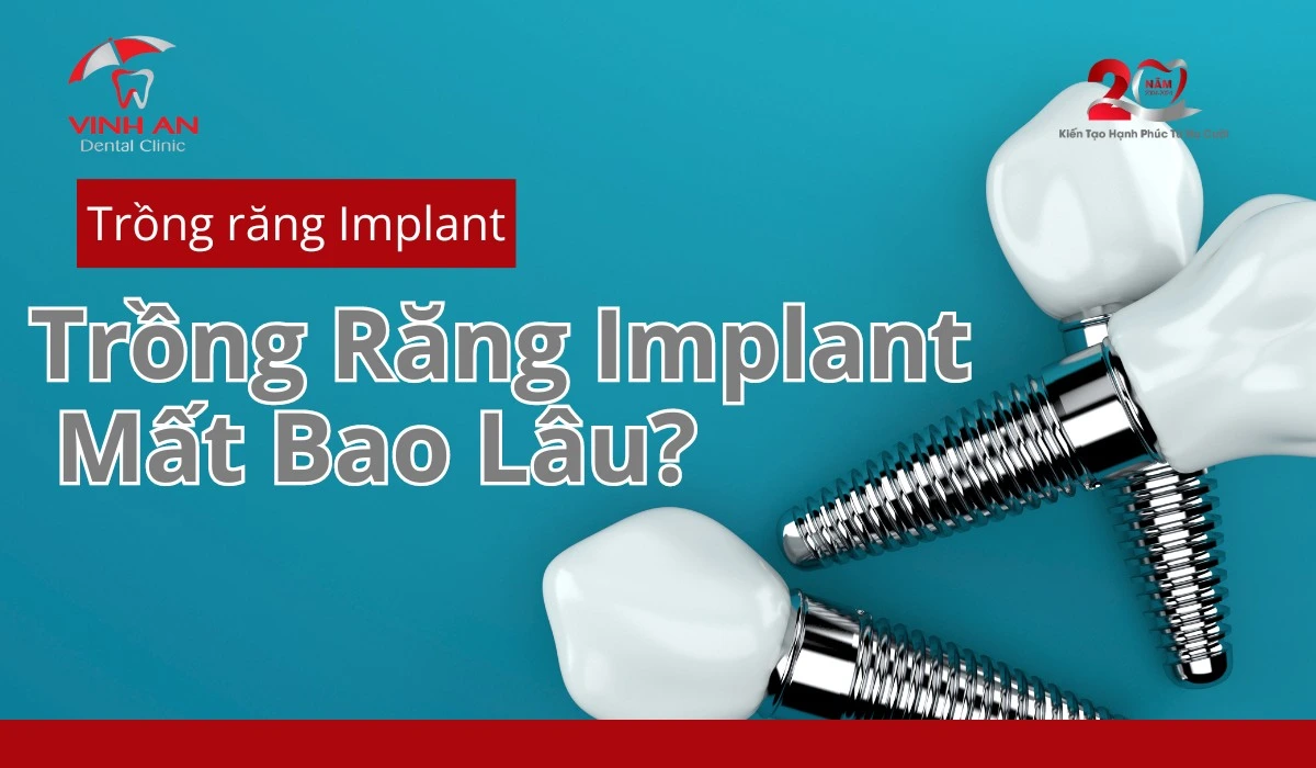 Trồng Răng Implant Mất Bao Lâu