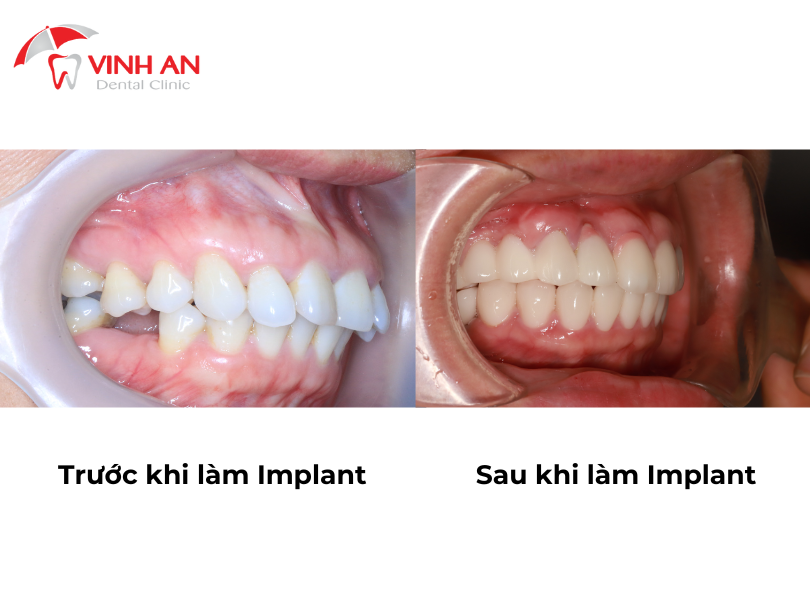 Trước Và Sau Khi Trồng Răng Implant