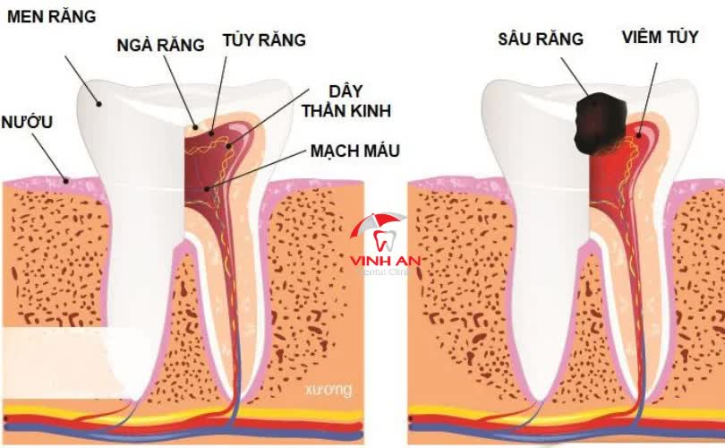 viêm tủy hỏng răng gốc