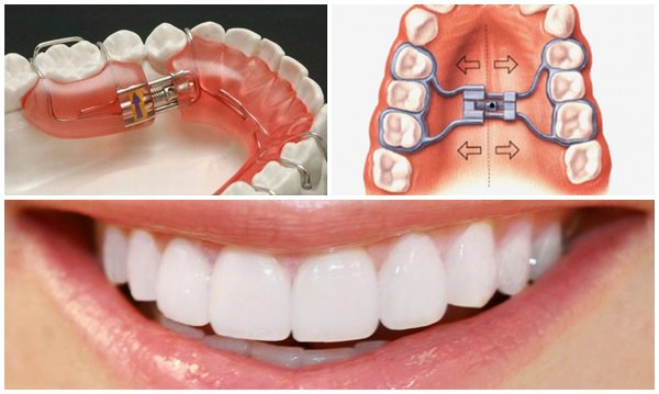 Tổng Hợp 13 Loại Khí Cụ Chỉnh Nha 