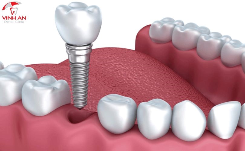 trồng răng Implant bao nhiêu tiền 1 cái