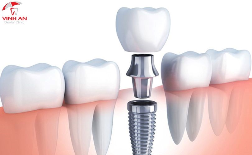 trồng răng Implant bao nhiêu tiền 1 cái