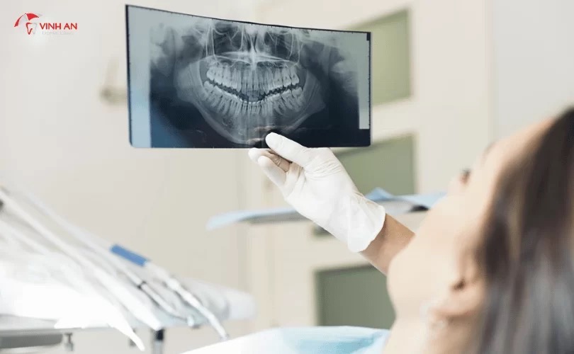 Trồng răng implant ở đâu tốt?