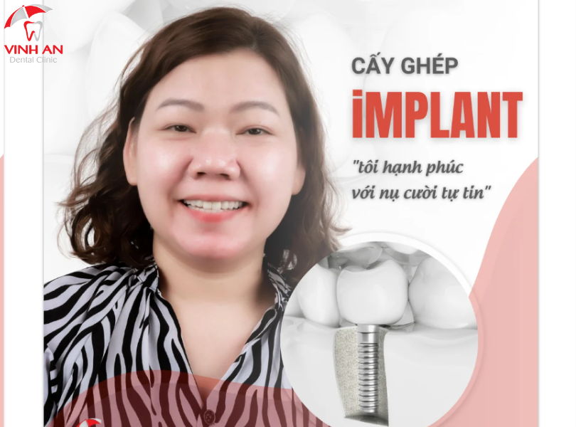 Sau Khi Trồng Răng Implant Có Bị Hôi Miệng Không ?3
