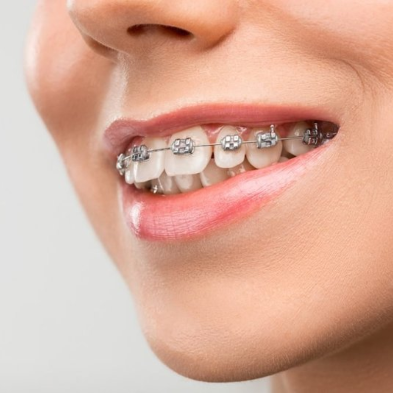 Tổng Hợp 13 Loại Khí Cụ Chỉnh Nha Phổ Biến Nhất Hiện Nay