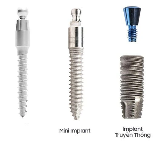 Cay-ghep-mini-implant