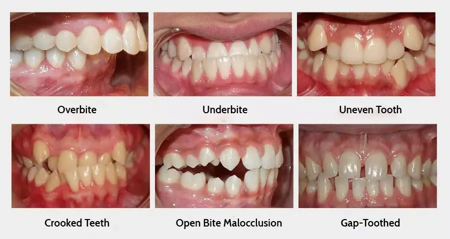 BRACELETS - ORTHODONTICS