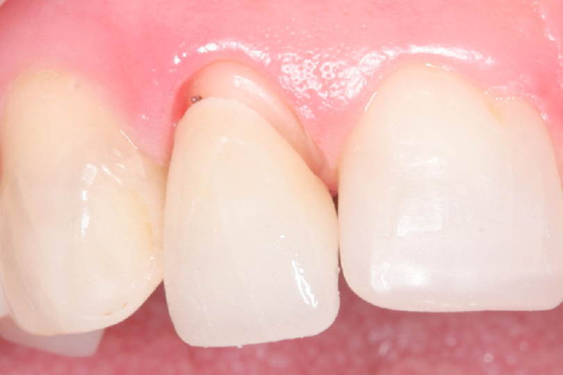 Hậu quả bọc răng sứ