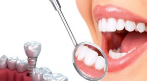 Trồng Răng Implant Ở Đâu Tốt? Top Địa Chỉ Cắm Trụ Implant?