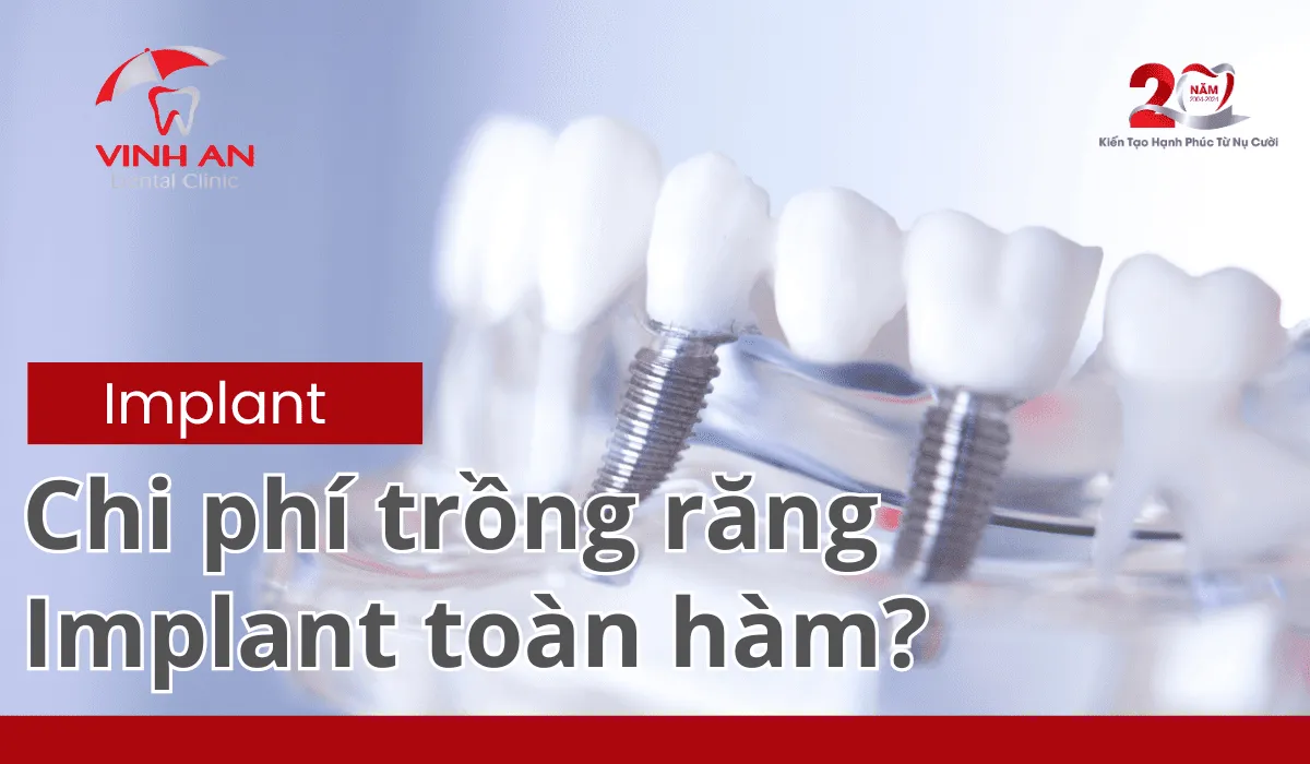 Implant Toàn Hàm