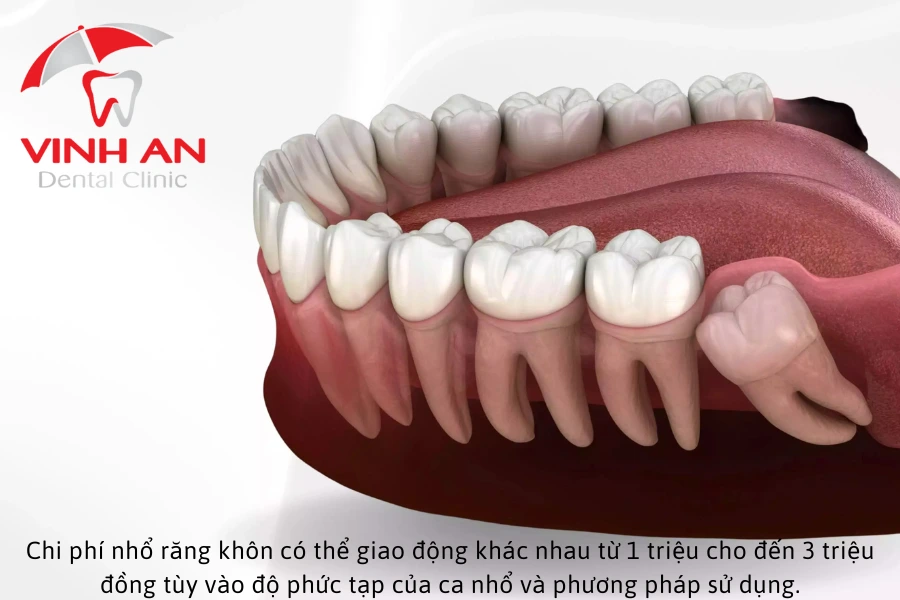 Chi phí để loại bỏ 1 chiếc răng có thể dao động khác nhau