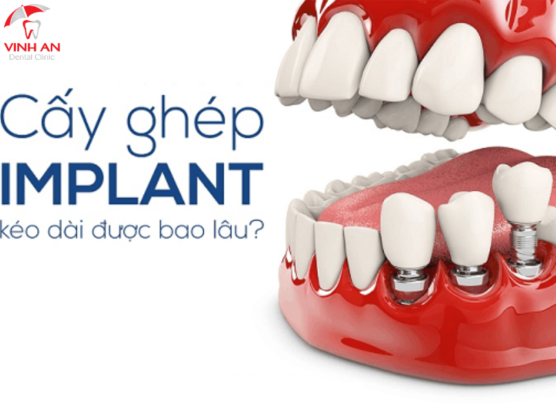 Mất Răng Lâu Lăm Có Trồng Implant Được Không? 
