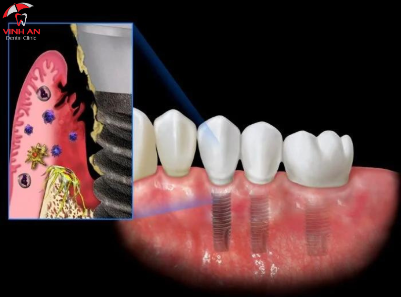 Mất Răng Lâu Lăm Có Trồng Implant Được Không? 