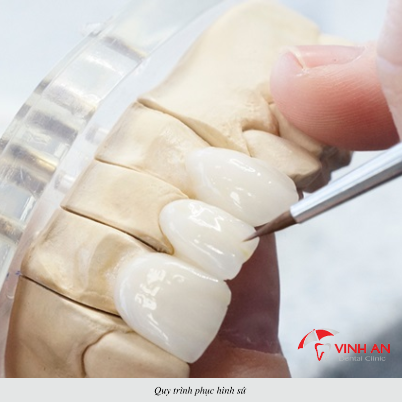 Yếu tố nào quyết định tuổi thọ bọc răng sứ được bao nhiêu năm?