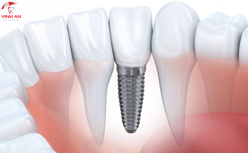 Trồng Răng Implant 5s 