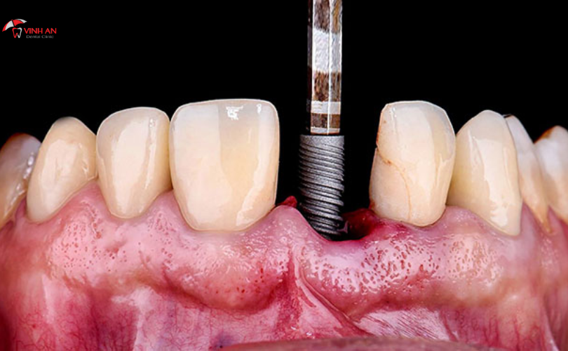 Bao Nhiêu Tuổi Thì Trồng Răng Implant Được? Điều Kiện Cần Có Để Trồng Răng Implant