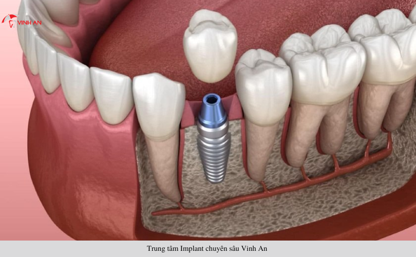 bao nhiêu tuổi thì trồng răng Implant được
