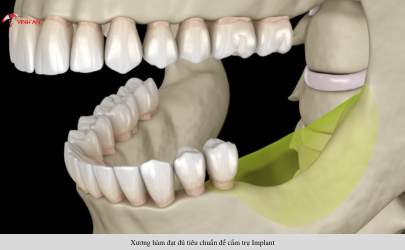 Điều kiện để trồng răng Implant thành công và hiệu quả