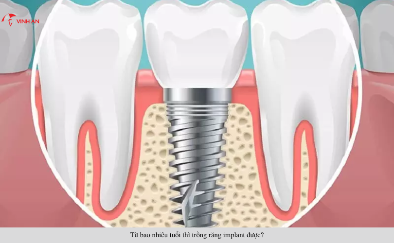 Từ bao nhiêu tuổi thì trồng răng implant được?