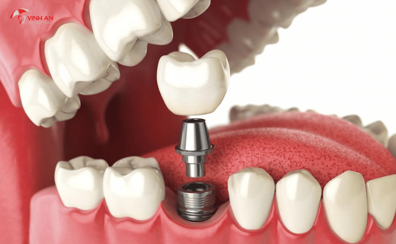 bệnh nha chu thì có trồng răng Implant được không