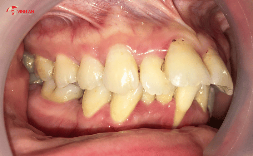 bệnh nha chu thì có trồng răng Implant được không