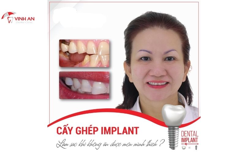 Cắm implant răng cửa