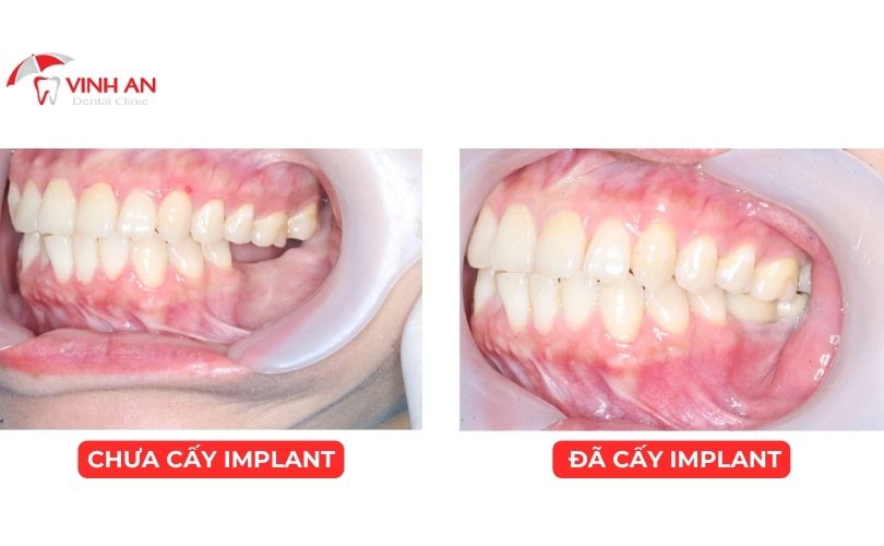 danh sách bác sĩ trồng răng implant giỏi tphcm