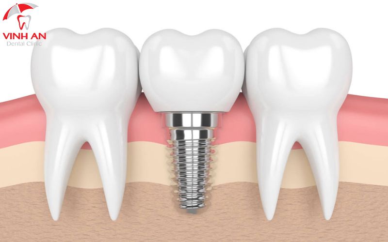 Đối tượng phù hợp với trồng răng Implant