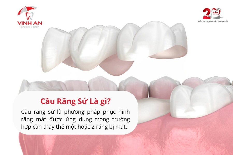 Nen-trong-rang-su-hay-implant