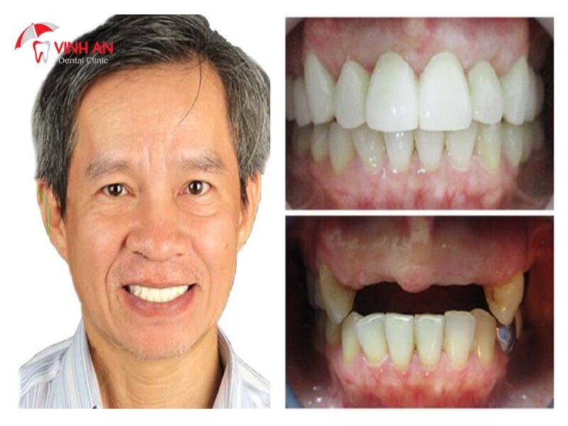 Review Trồng Răng Implant